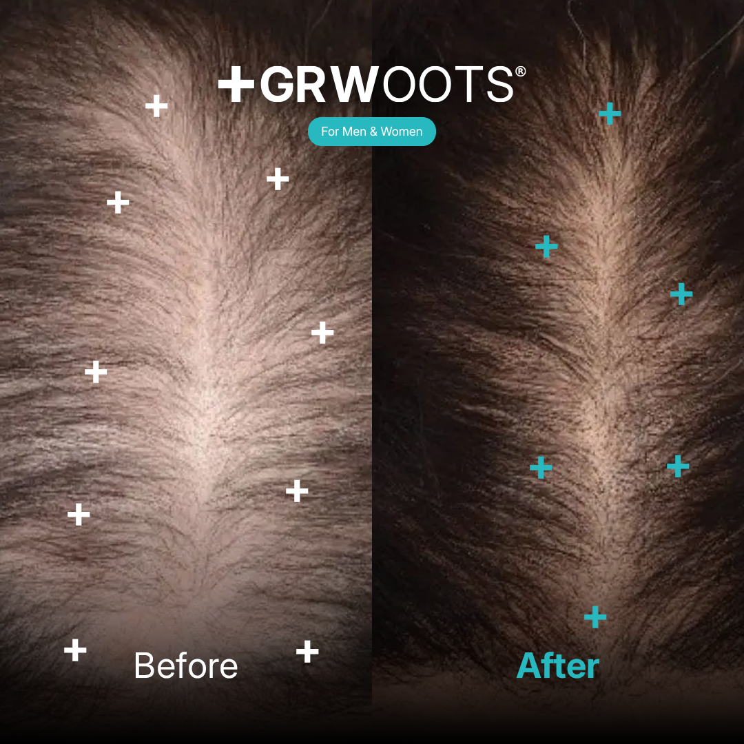 GRWOOTS® Micro-Infusion Growth Treatment