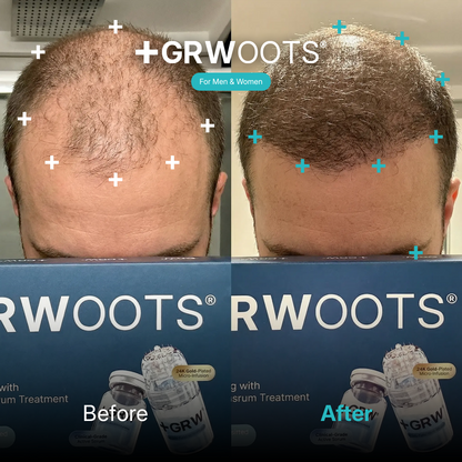 GRWOOTS® Micro-Infusion Haargroeibehandeling