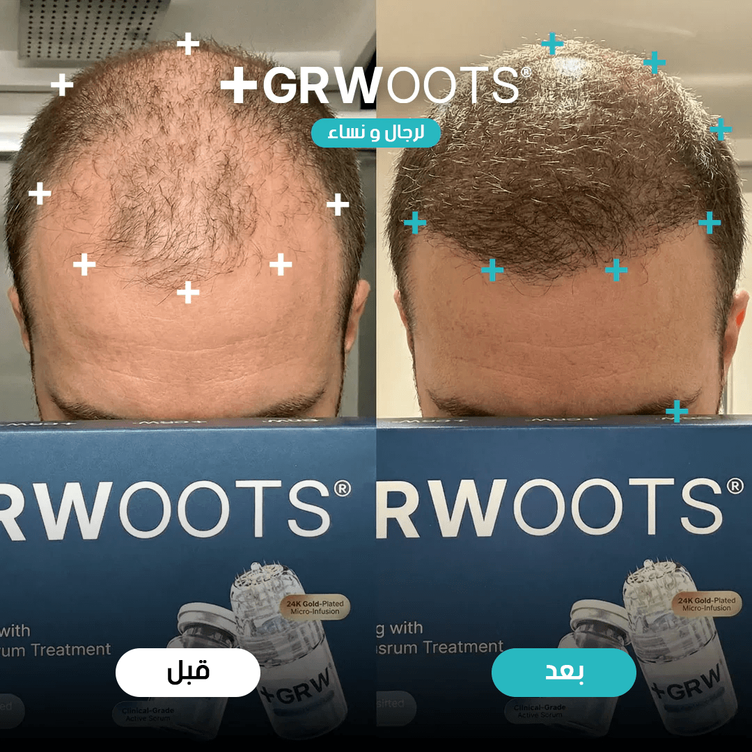 GRWOOTS® علاج بالحقن المجهري لتساقط الشعر ودعم نمو شعر أقوى وأكثر كثافة