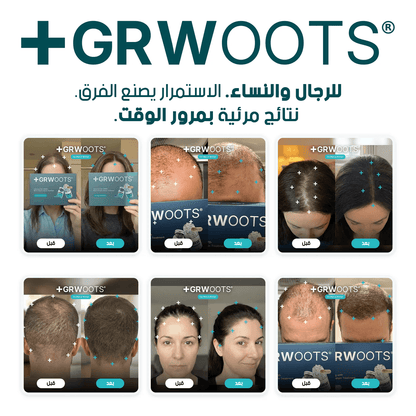 GRWOOTS® علاج بالحقن المجهري لتساقط الشعر ودعم نمو شعر أقوى وأكثر كثافة