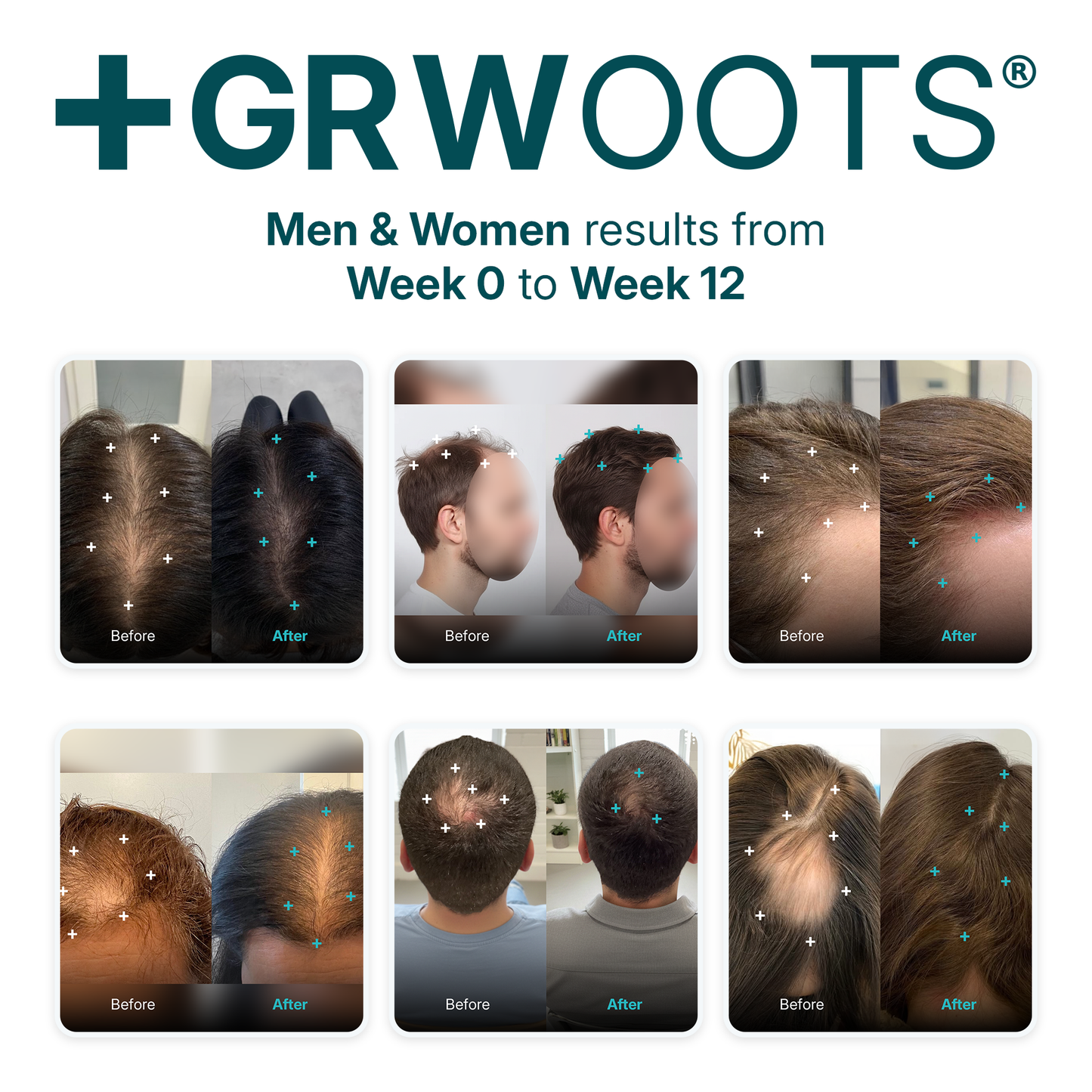GRWOOTS® Micro-Infusion Growth Treatment