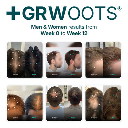 GRWOOTS® Micro-Infusion Growth Treatment