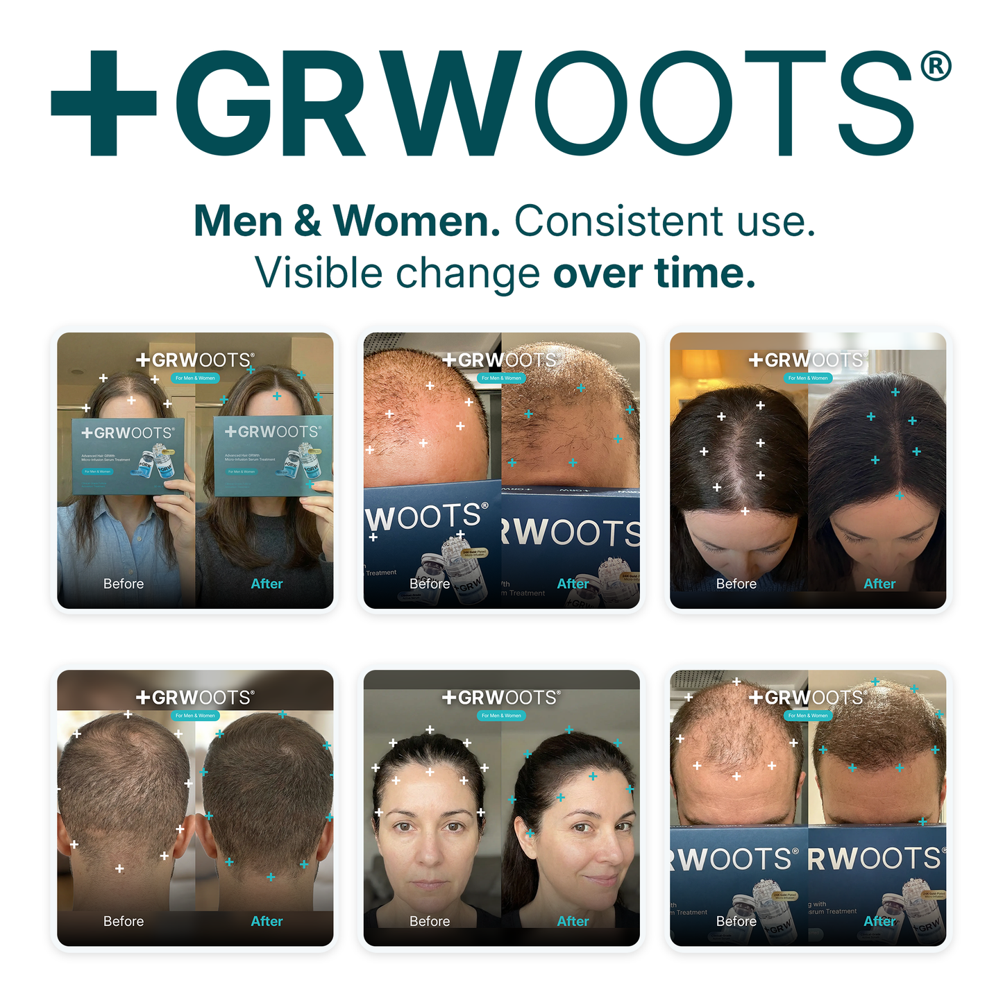 GRWOOTS® Micro-Infusion Haargroeibehandeling