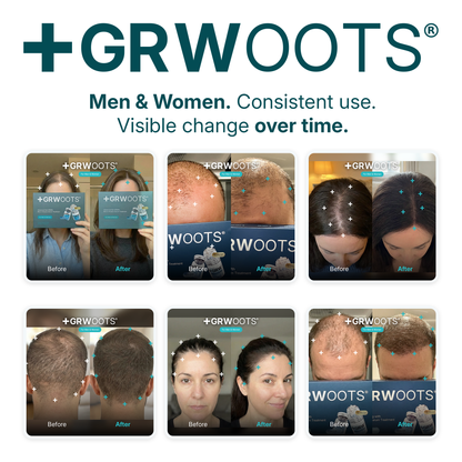 GRWOOTS® Micro-Infusion Haargroeibehandeling